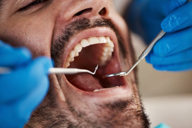Best Emergency Dentist for Lost Fillings or Crowns in Excelsior Springs, MO