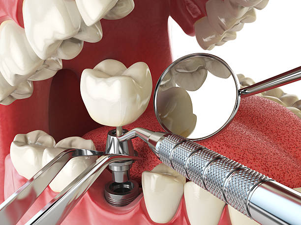 Best Emergency Dental Extractions in Excelsior Springs, MO